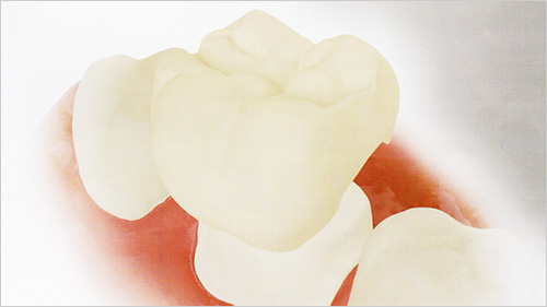 CAD/CAM冠　大臼歯